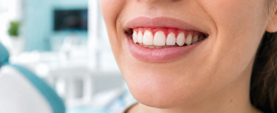 Why are my gums bleeding? Is it normal?