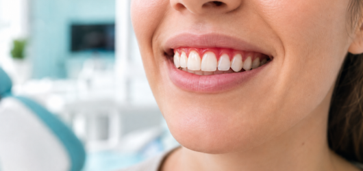 Why are my gums bleeding? Is it normal?